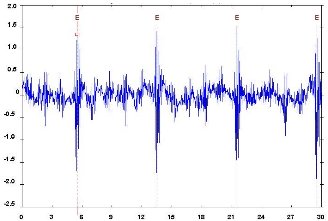 Tooth Repeat Signal (source: DDC) Machine Vibration Spectrum Analysis - Detecting Faults (5) - Tooth Repeat Signal (source: DDC)